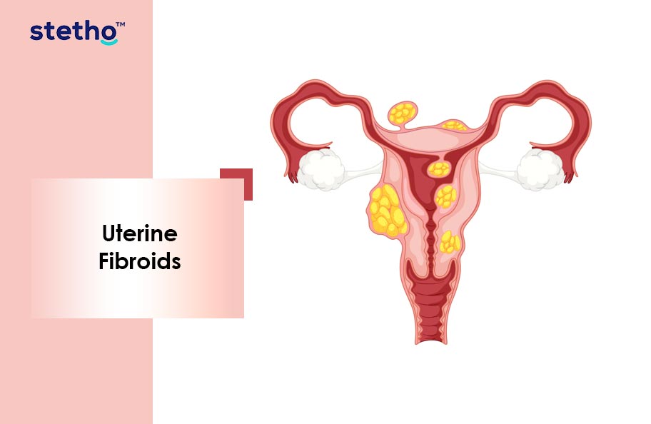 Hormonal Imbalance